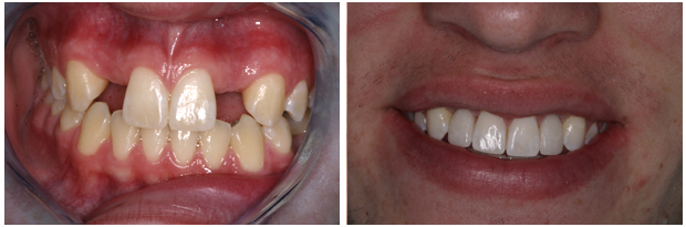 Smile Gallery - Implant Restorations